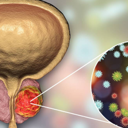 Cáncer de Próstata