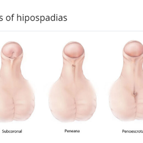Hipospadias