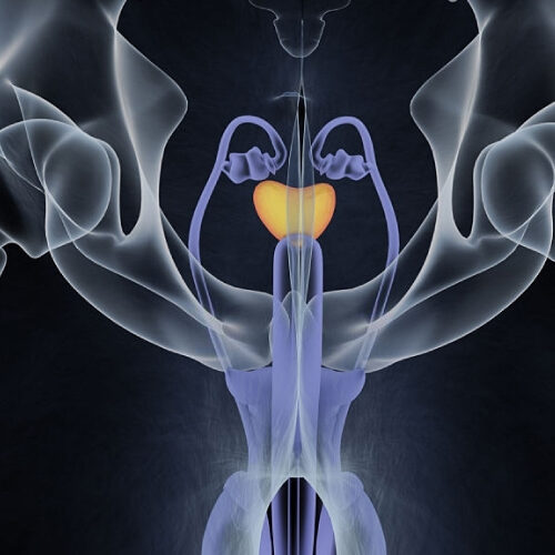 ¿Qué significa tener hiperplasia benigna de próstata?