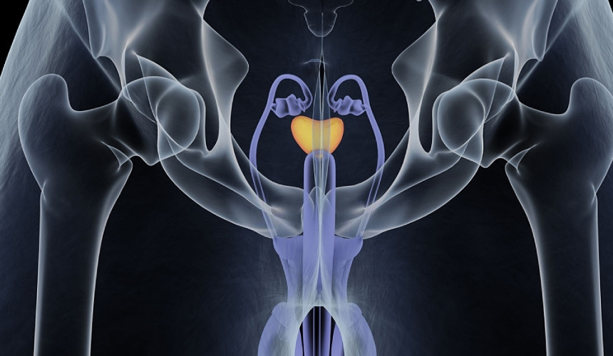 ¿Qué significa tener hiperplasia benigna de próstata?