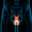 Todo lo que debe saber sobre la inflamación escrotal