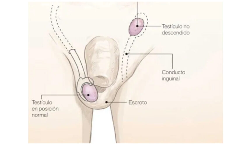 Urología en Monterrey: ¿Cuándo operar testículo no descendido?